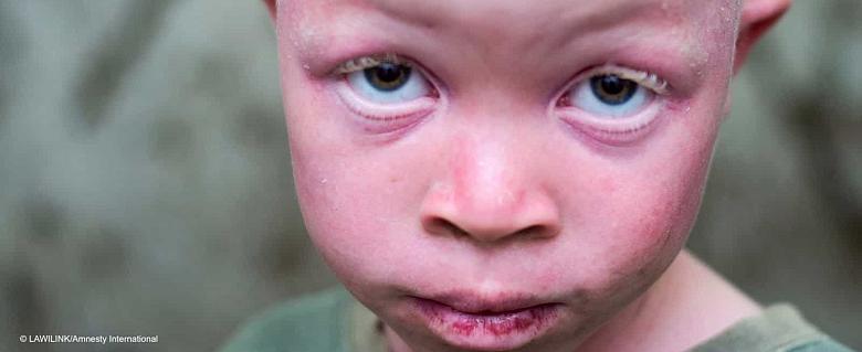 Malawi Albinos Ian Muhamba